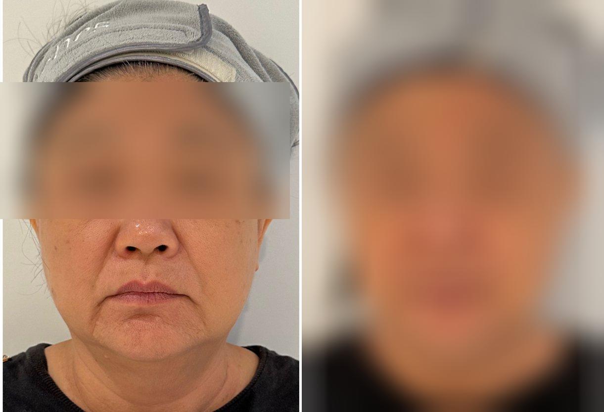VF Facelift - Lifts Nasolabial Folds Jowls Double Chin